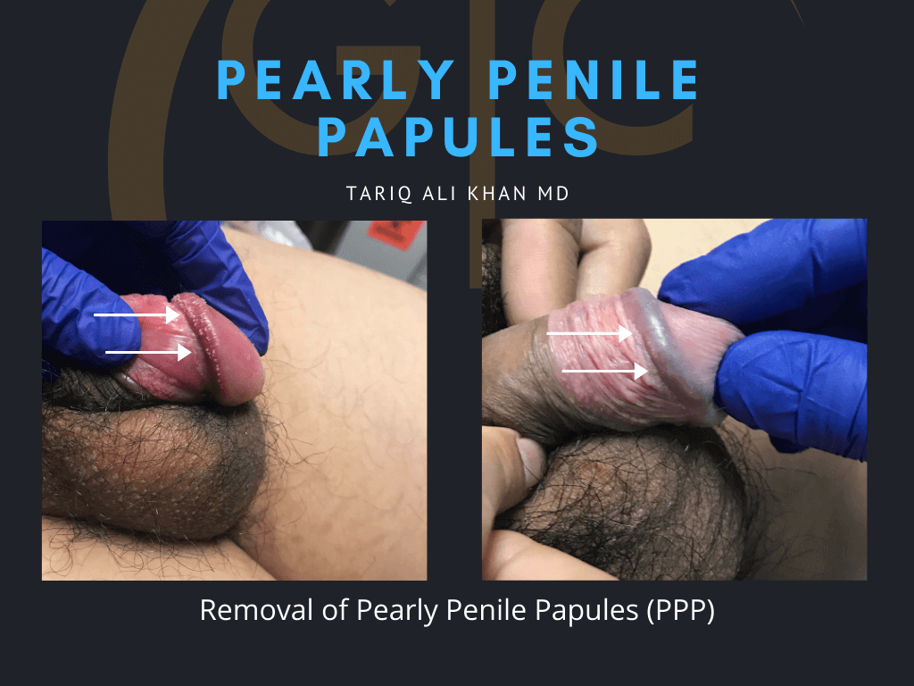 Gentle Care Laser Tustin Before and After picture - pearly penile
                  papules